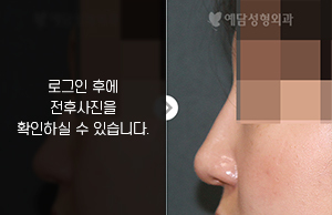 메부리코성형