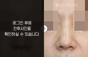 코재수술(돌출현상 교정)