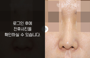 낮은코성형(비중격 연골 휨 발생)