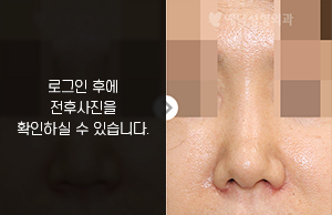 낮은코성형