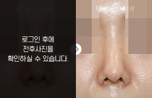 코재수술