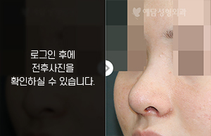 무보형물코성형