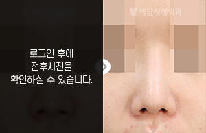 낮은코성형