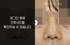 코재수술(보형물 휨 개선)