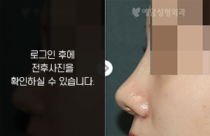 코재수술