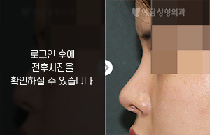 메부리코성형