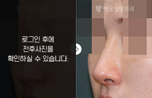 메부리코성형