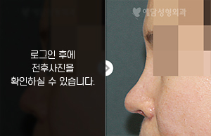코재수술(비주 흉터 및 실리콘 주변 석회화 개선)