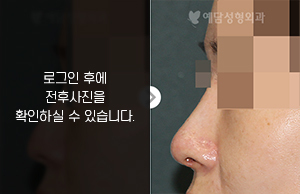 메부리코성형
