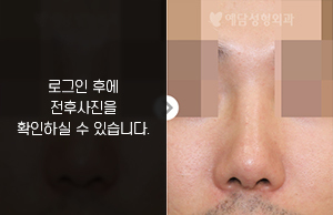 낮은코성형