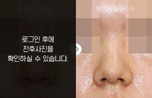 콧볼축소성형